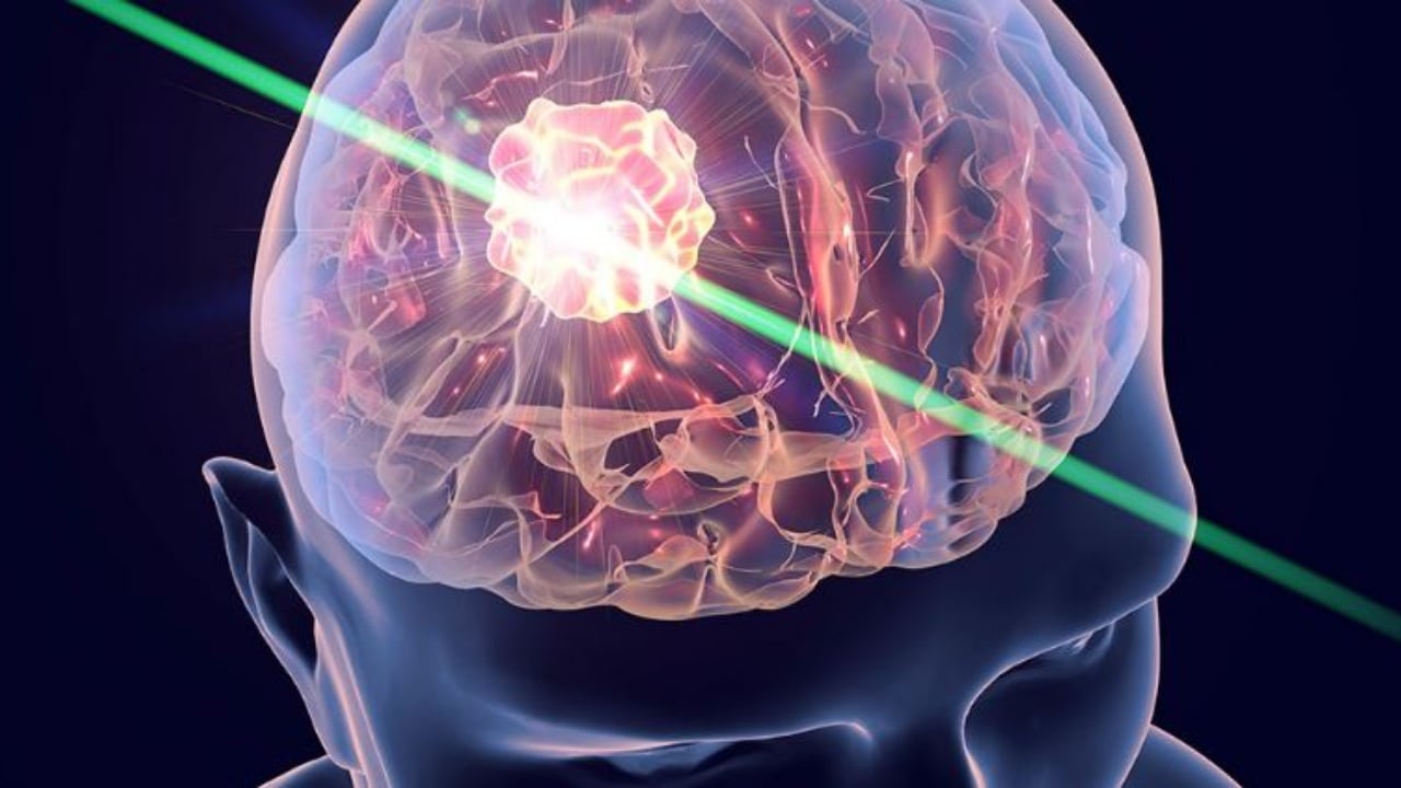 Increases the chances of survival, the world’s first blood test for brain tumor is developed